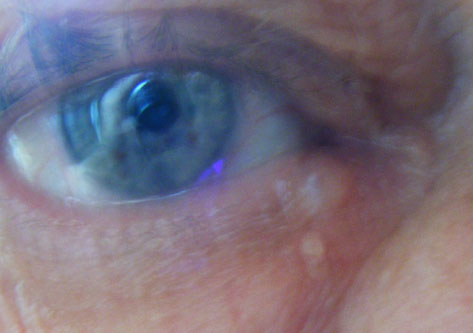 Blase Im Auge Blase Im Auge